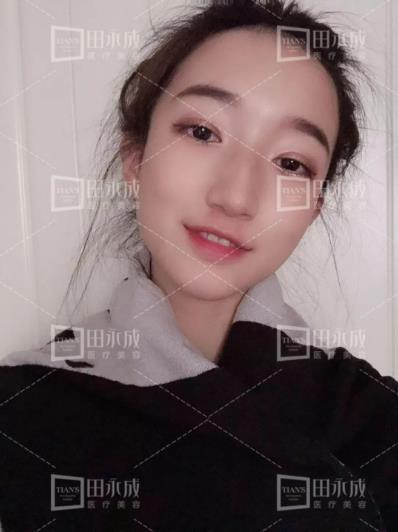銀川田永成整形做雙眼皮好不好 美是需要“整”理的微整形
