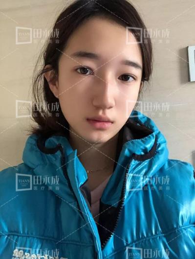 銀川田永成整形做雙眼皮好不好 美是需要“整”理的微整形