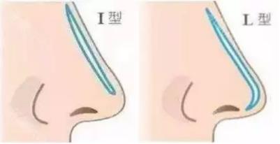 廈門臉博士整形醫(yī)院埃菲爾隆鼻 自然美鼻大家共享