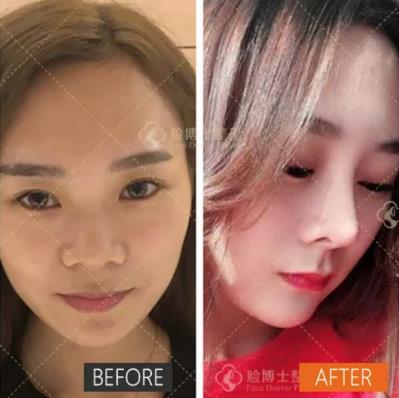 廈門臉博士整形醫(yī)院埃菲爾隆鼻 自然美鼻大家共享