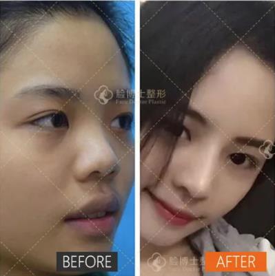 廈門臉博士整形醫(yī)院埃菲爾隆鼻 自然美鼻大家共享