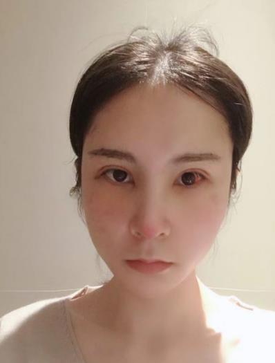 深圳米蘭柏羽黎慧娟醫(yī)生做雙眼皮效果怎么樣 遇見完美自己