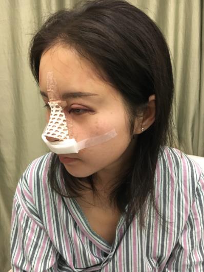 深圳米蘭柏羽黎慧娟醫(yī)生做雙眼皮效果怎么樣 遇見完美自己