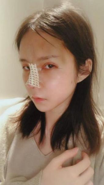 深圳米蘭柏羽黎慧娟醫(yī)生做雙眼皮效果怎么樣 遇見完美自己