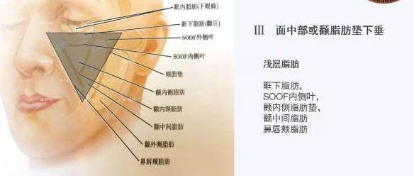 北京伊美爾幸福醫(yī)院姚紅偉:超聲刀和線雕哪個更好