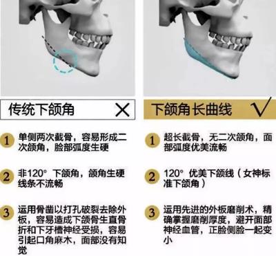 成都嬌點(diǎn)整形下頜角 曲線截骨術(shù)前術(shù)后對比