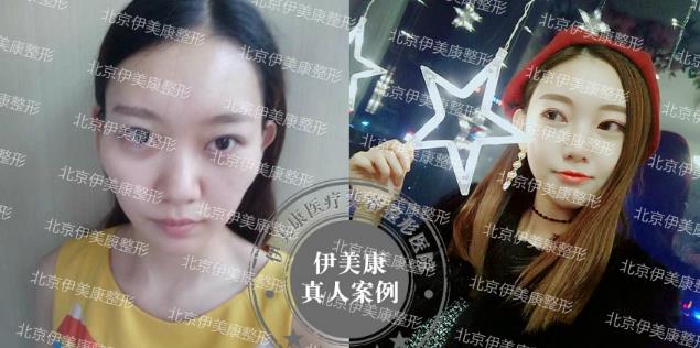 北京伊美康:掌握童顏三件套,你也像吃了防腐劑一樣年輕