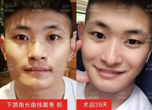 成都嬌點(diǎn)整形下頜角 曲線截骨術(shù)前術(shù)后對比