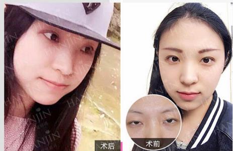 昆明韓辰楊瑞年院長 我只專注眼部整形