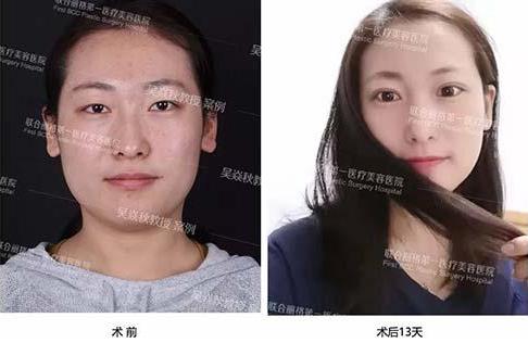 聯(lián)合麗格第一醫(yī)院:做雙眼皮手術(shù)是全切還是埋線(xiàn)