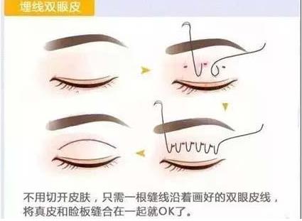 聯(lián)合麗格第一醫(yī)院:做雙眼皮手術(shù)是全切還是埋線(xiàn)