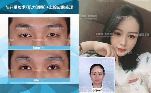 聯(lián)合麗格第一醫(yī)院:做雙眼皮手術(shù)是全切還是埋線(xiàn)