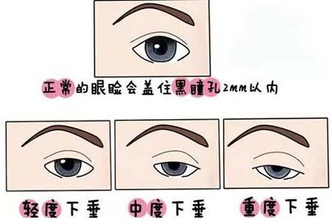 聯(lián)合麗格第一醫(yī)院:做雙眼皮手術(shù)是全切還是埋線(xiàn)