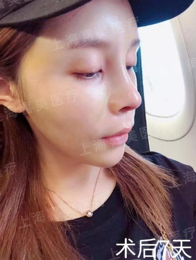 喜美科普誰做過隆鼻修復手術?采用什么方案較好?