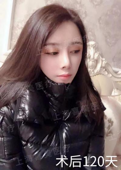 喜美科普誰做過隆鼻修復手術?采用什么方案較好?