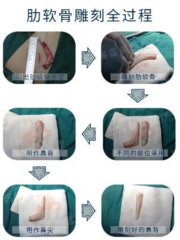 喜美科普誰做過隆鼻修復手術?采用什么方案較好?
