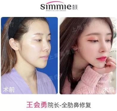 喜美科普誰做過隆鼻修復手術?采用什么方案較好?