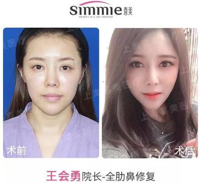 喜美科普誰做過隆鼻修復手術?采用什么方案較好?