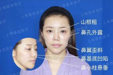 喜美科普誰做過隆鼻修復手術?采用什么方案較好?