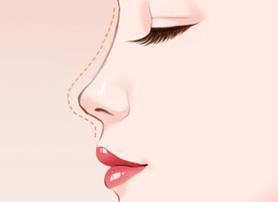 福州格萊美醫(yī)院隆鼻:鐘德成院長解析3+3立挺半肋鼻綜合