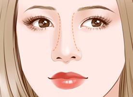福州格萊美醫(yī)院隆鼻:鐘德成院長解析3+3立挺半肋鼻綜合