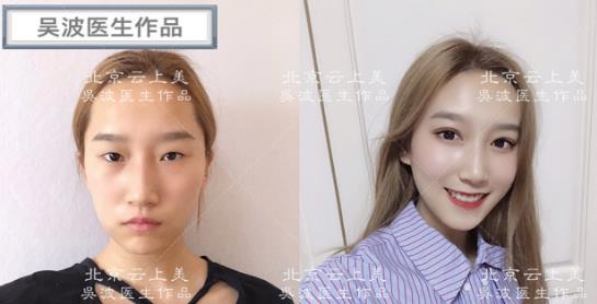 想要雙眼靈動(dòng)傳神、自然唯美?吳波院長推薦笛波卡爾綜合美眼術(shù)