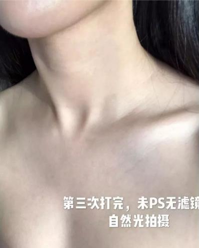 廈門薇格整形醫(yī)院去頸紋效果如何 告訴你年輕的秘密