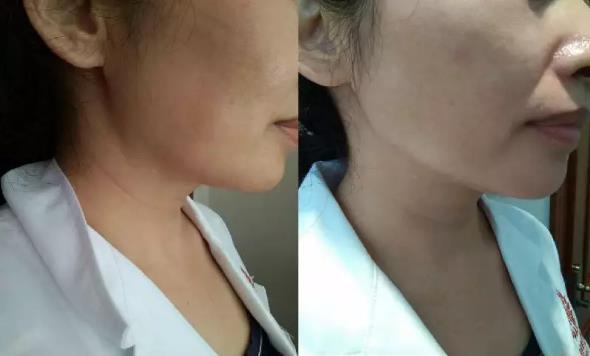 廈門薇格整形醫(yī)院去頸紋效果如何 告訴你年輕的秘密