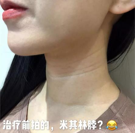廈門薇格整形醫(yī)院去頸紋效果如何 告訴你年輕的秘密