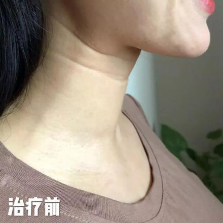 廈門薇格整形醫(yī)院去頸紋效果如何 告訴你年輕的秘密