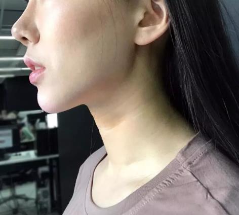 廈門薇格整形醫(yī)院去頸紋效果如何 告訴你年輕的秘密