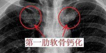 北京伊美爾健翔醫(yī)院:肋軟骨隆鼻多少錢