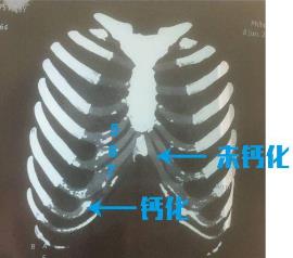 北京伊美爾健翔醫(yī)院:肋軟骨隆鼻多少錢