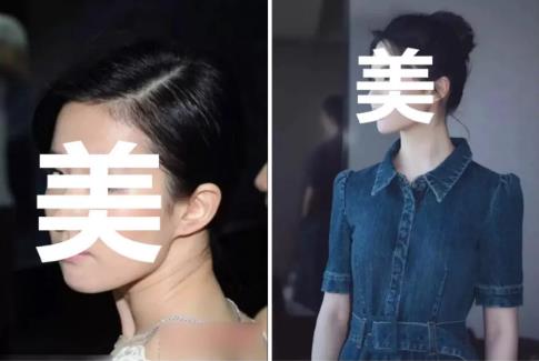 頸紋出現(xiàn)怎么辦?廈門薇格整形醫(yī)院拯救你