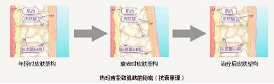 北京伊美爾愛(ài)康醫(yī)院:新熱瑪吉有什么功效