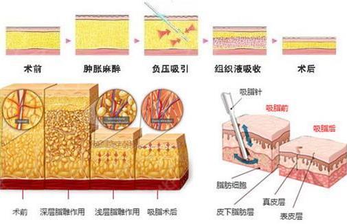 南京怡華整形背部吸脂效果怎么樣 輕松享瘦S曲線