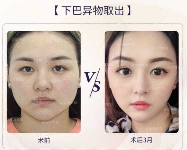 王紹國院長詳解:奧美定取出“清奧”勢在必行