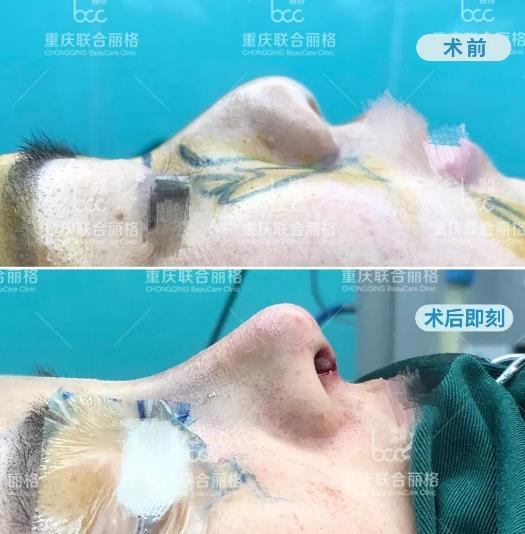 重慶聯(lián)合麗格全肋隆鼻 Battle 半肋隆鼻 ,我該如何選?