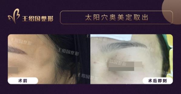 奧美定不取出的后遺癥:王紹國院長詳解