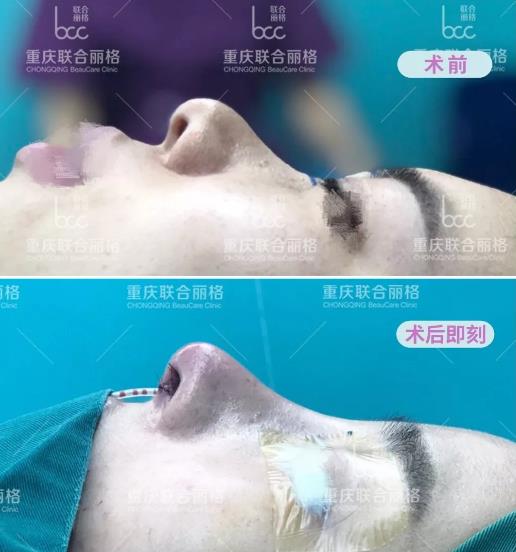 重慶聯(lián)合麗格全肋隆鼻 Battle 半肋隆鼻 ,我該如何選?
