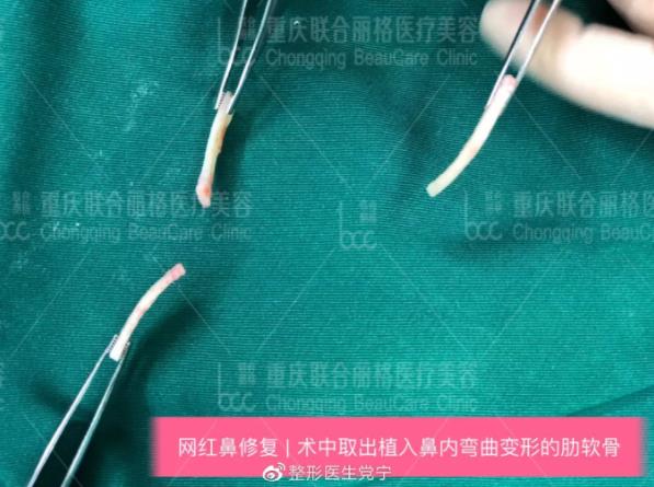 重慶聯(lián)合麗格全肋隆鼻 Battle 半肋隆鼻 ,我該如何選?