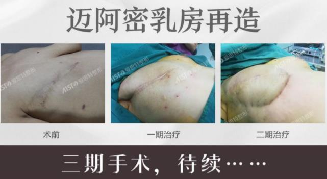愛思特張敏邁阿密乳房再造口碑如何,有案例嗎?