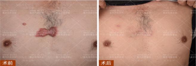 重慶瑪恩皮膚醫(yī)院司洛德發(fā)明人鄧軍怎么樣?業(yè)內(nèi)祛疤權(quán)威