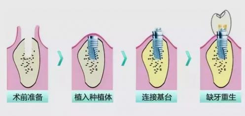 岳陽種植牙哪里最好?歷時三月,終于做完種植牙!