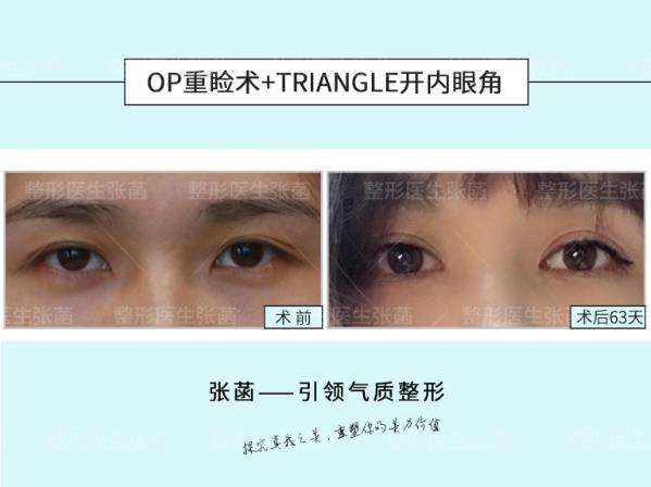 埋線雙眼皮、韓式三點(diǎn)及菡式OP重瞼術(shù)哪種方式更適合你吶?