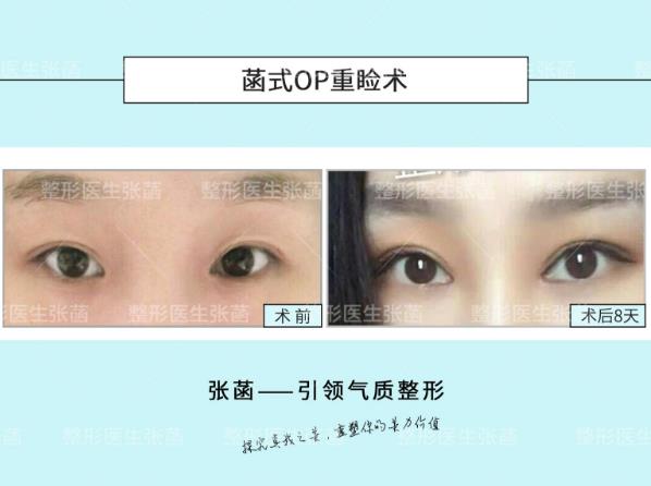 埋線雙眼皮、韓式三點(diǎn)及菡式OP重瞼術(shù)哪種方式更適合你吶?