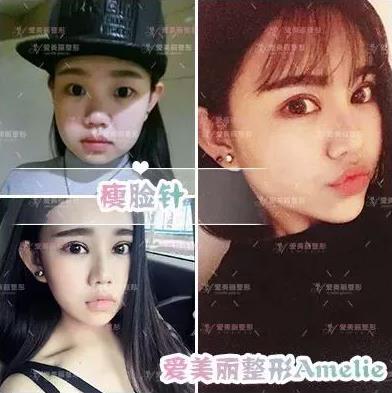 鄭州愛美麗醫(yī)院,有一種肉毒素,打了“它”,男友比原來更加愛你了!