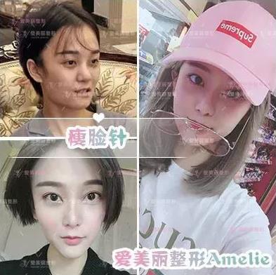 鄭州愛美麗醫(yī)院,有一種肉毒素,打了“它”,男友比原來更加愛你了!