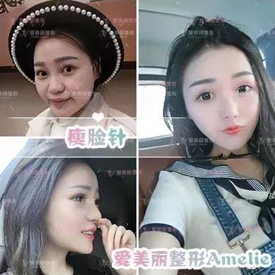 鄭州愛美麗醫(yī)院,有一種肉毒素,打了“它”,男友比原來更加愛你了!
