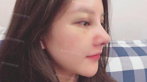 成都黃富偉這個(gè)醫(yī)生做鼻子撒樣?